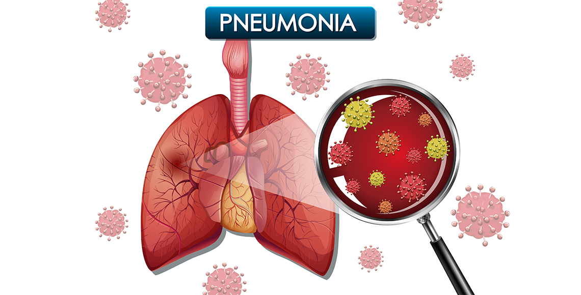 Atipična pneumonija