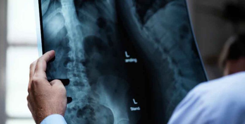 RTG kičme - pregled kičmenog stuba