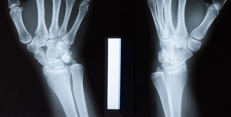 Rendgen ruke - snimanje nadlaktice i podlaktice