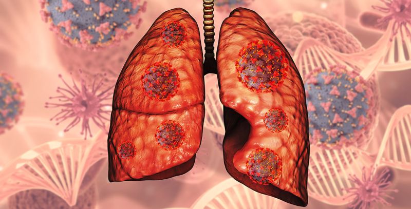 Maligni tumor pluća