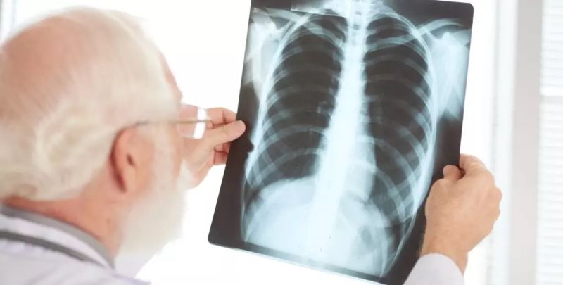 MSCT pluća - rano otkrivanje promena