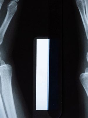 Rendgen ruke - snimanje nadlaktice i podlaktice