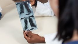 ARDS - Akutni respiratorni distres sindrom: simptomi, dijagnoza i lečenje