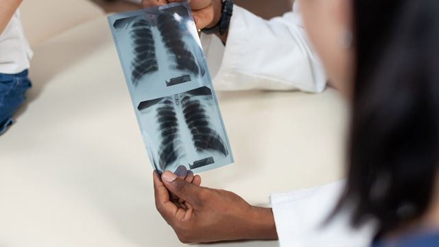 ARDS - Akutni respiratorni distres sindrom: simptomi, dijagnoza i lečenje ARDS - Akutni respiratorni distres sindrom: simptomi, dijagnoza i lečenje