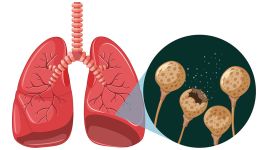 Atelektaza pluća: Uzroci, simptomi i lečenje