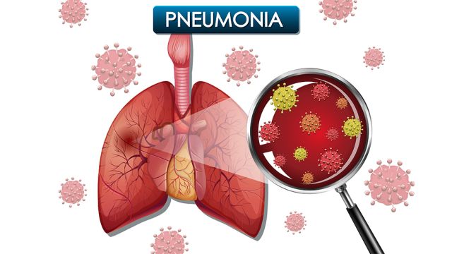 Simptomi i lečenje atipične pneumonije Simptomi i lečenje atipične pneumonije