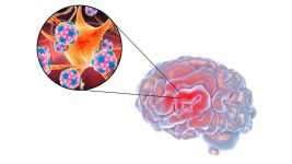 Encefalitis: Sve što treba da znate o upali mozga