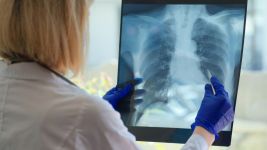 Uzroci, simptomi i lečenje mezotelioma