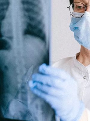 MSCT pluća - rano otkrivanje promena