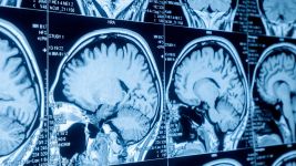 Uzroci i simptomi ishemije mozga