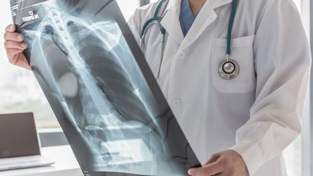 Fibrotoraks: Tretmani i prevencija bolesti grudnog koša Fibrotoraks: Tretmani i prevencija bolesti grudnog koša
