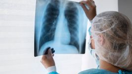 Stenoza plućne arterije: uzroci, simptomi i lečenje