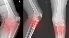 Uzroci i simptomi preloma patele