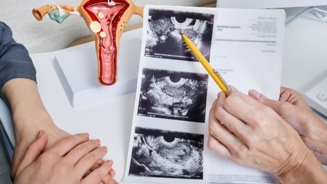 Teratom jajnika: uzroci, simptomi i lečenje Teratom jajnika: uzroci, simptomi i lečenje