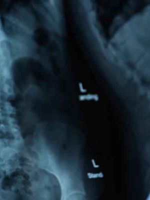 RTG kičme - pregled kičmenog stuba