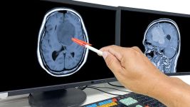 Glioblastom: Razumevanje najagresivnijeg tumora mozga