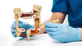 Neoplazma rektuma: uzroci, dijagnoza i terapije