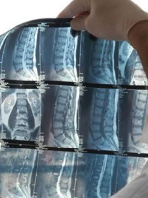 MRI Beograd - Magnetna rezonanca kičme